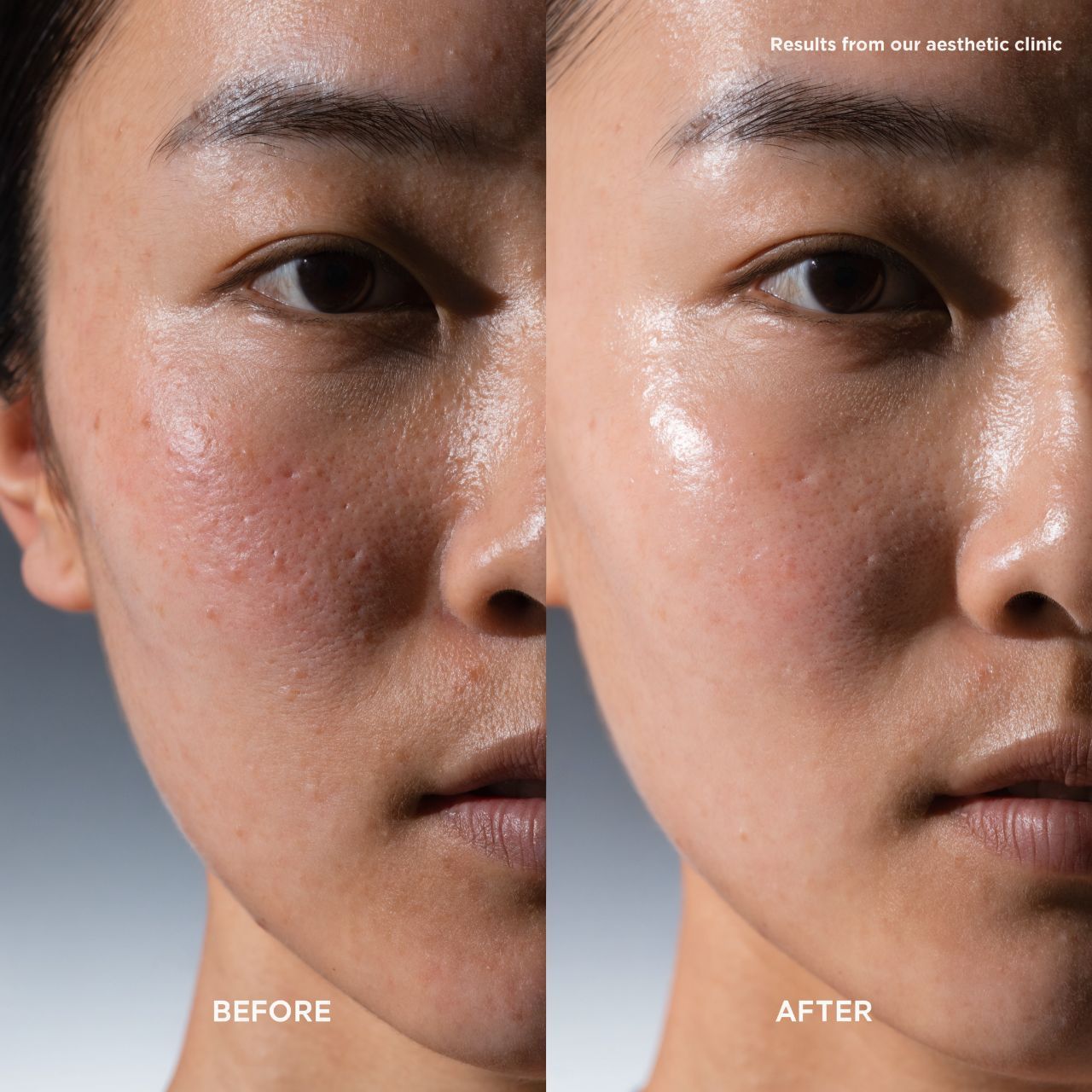 Jawline contouring result — refined, natural profile and structure