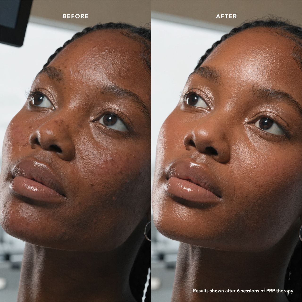 Skin rejuvenation result — improved texture and luminosity with Profhilo